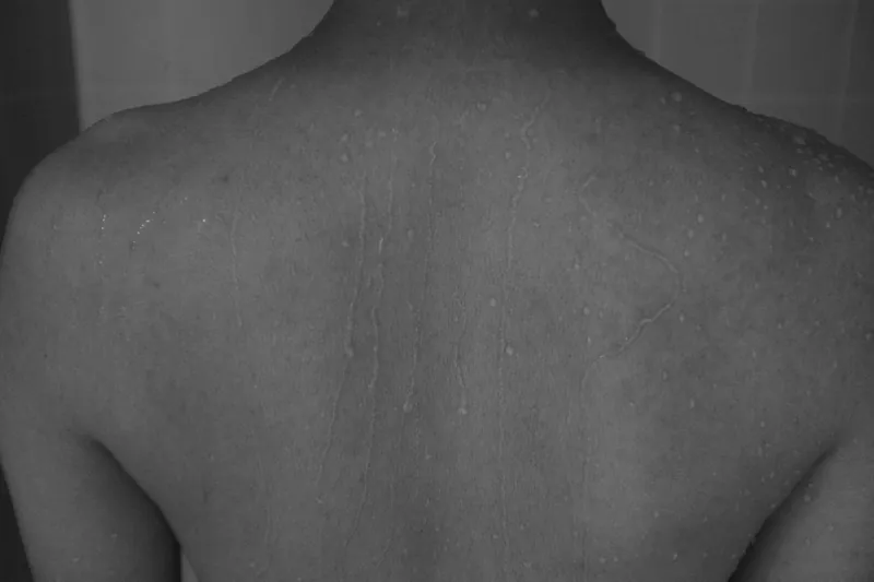 gray-skin.webp